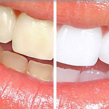 Chad Byler, DDS - Free Whitening for Life! - General Dentistry Near Me - Bastrop, Texas Chad Byler, DDS - Free Whitening for Life! - General Dentistry Near Me - Bastrop, Texas