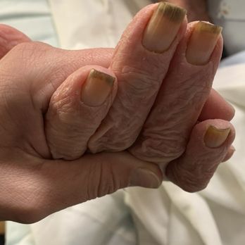 Whitney Oaks Care Center - Poop under nails - Physical Therapy Near Me - Carmichael, California Whitney Oaks Care Center - Poop under nails - Physical Therapy Near Me - Carmichael, California
