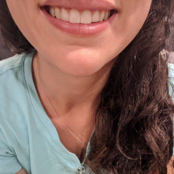 Thomas E Gaffaney, DDS - One year post op- gum didn't grow back down since doctor did an amazing job! Finally done with my aligners. Still loving my smile! - Periodontists Near Me - Whittier, California