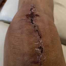 Day 7 after removing the surgical tape. Day 7 after removing the surgical tape.