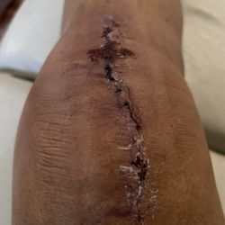 Rasmussen J Linda, MD - Day 7 after removing the surgical tape.