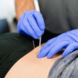 Axes Physical Therapy - O'Fallon, MO - Trigger Point Dry Needling