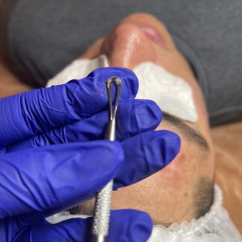 Michellexskin - Extractions - Estheticians Near Me - Torrance, California Michellexskin - Extractions - Estheticians Near Me - Torrance, California