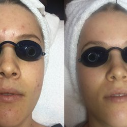 After 2 months of rotating bi-weekly chemical peels & silkpeels.