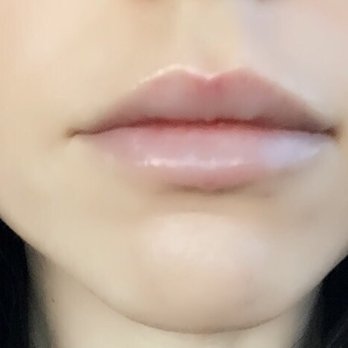 Glo Medspa - So happy with my results! I syringe of Juvederm Ultra XC - Medical Spas Near Me - Scottsdale, Arizona Glo Medspa - So happy with my results! I syringe of Juvederm Ultra XC - Medical Spas Near Me - Scottsdale, Arizona
