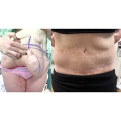 Escape Medical - Tummy Tuck Before & After