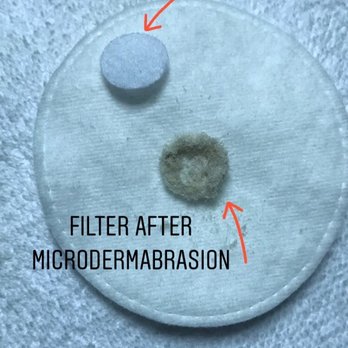 Refresh Skin Lab - Microdermabrasion filter full of dead skin cells - Skin Care Near Me - Aurora , Colorado Refresh Skin Lab - Microdermabrasion filter full of dead skin cells - Skin Care Near Me - Aurora , Colorado
