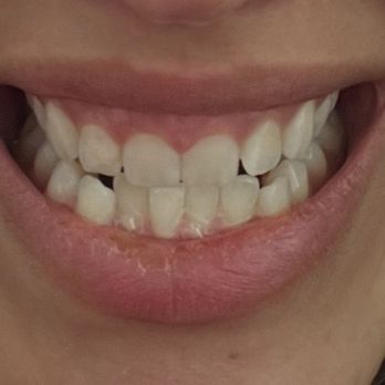 Michael J Perona, DDS - Still crooked after Invisalign with Perona - General Dentistry Near Me - San Francisco, California Michael J Perona, DDS - Still crooked after Invisalign with Perona - General Dentistry Near Me - San Francisco, California