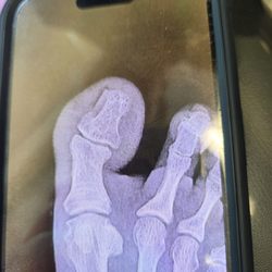 James Kutchback, DPM, CWS-P - My toes