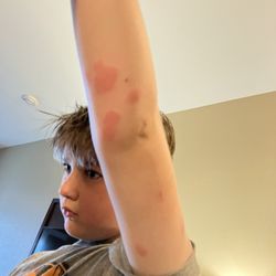 Son's arm covered in flea bites