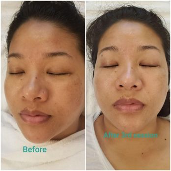Bliss and Sparrow - Just 3rd session I could see the difference! - Skin Care Near Me - Johns Creek, Georgia Bliss and Sparrow - Just 3rd session I could see the difference! - Skin Care Near Me - Johns Creek, Georgia