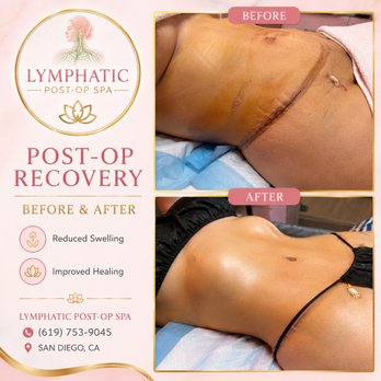 Lymphatic Post-Op Spa - Manual Lymphatic Drainage Post-Op Massage - Massage Near Me - San Diego, California Lymphatic Post-Op Spa - Manual Lymphatic Drainage Post-Op Massage - Massage Near Me - San Diego, California