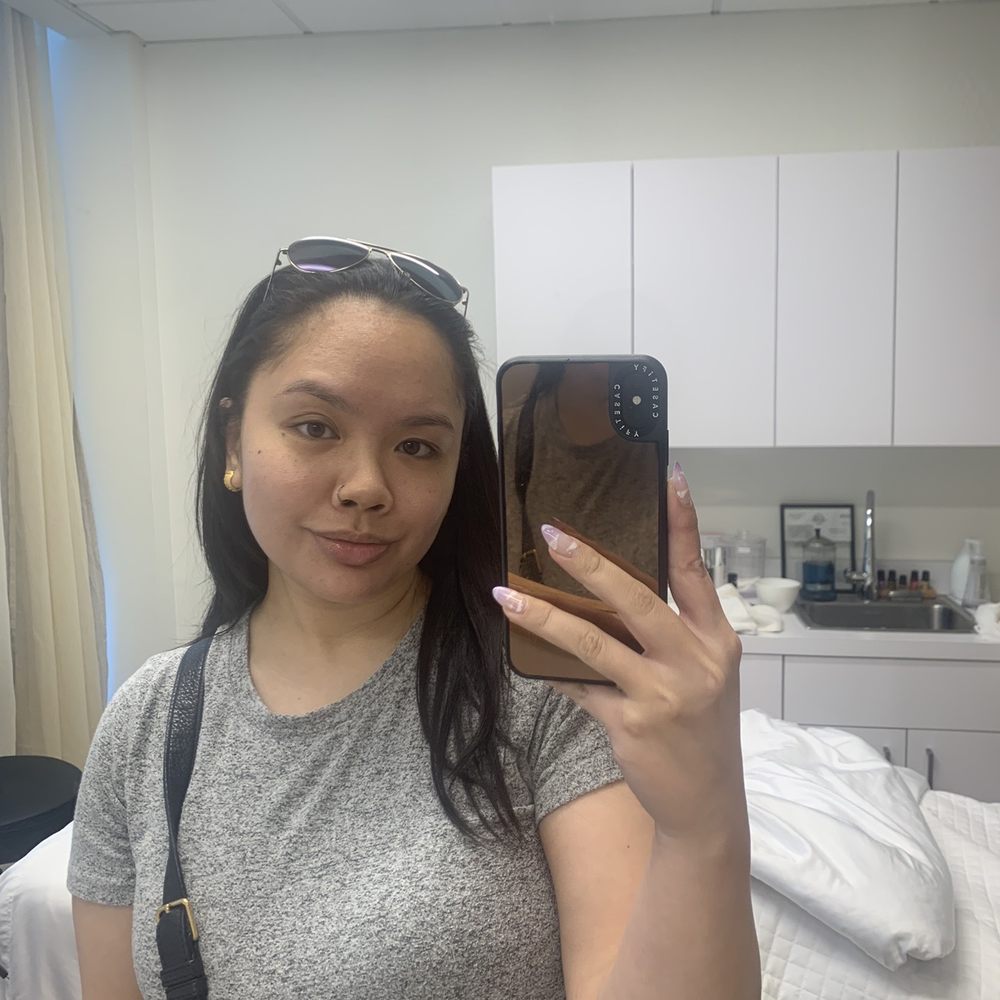 SkinScience Medical Spa - Hydra facial in may- after spf. Great results! - Medical Spas Near Me - Pleasant Hill, California SkinScience Medical Spa - Hydra facial in may- after spf. Great results! - Medical Spas Near Me - Pleasant Hill, California