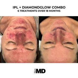 SkinMD Hyannis - With proper home care regimen of medical grade skin care products, this lovely patient greatly reduced her acne.