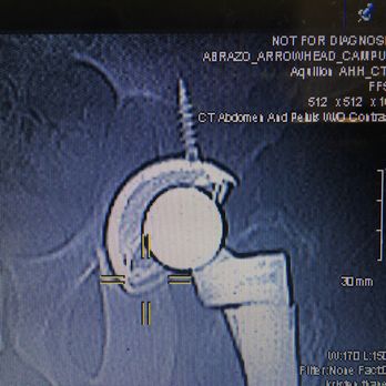 Firestone P Theodore, MD - Close up left hip it deteriorating, cup Is worn out Dr Firestone did a great job but office would not let me talk with him, money thing - Orthopedists Near Me - Scottsdale, Arizona Firestone P Theodore, MD - Close up left hip it deteriorating, cup Is worn out Dr Firestone did a great job but office would not let me talk with him, money thing - Orthopedists Near Me - Scottsdale, Arizona
