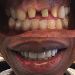 Dental clinic near Miami - Veneers