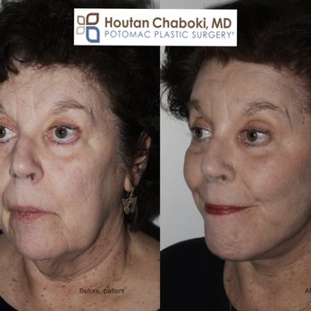 Houtan Chaboki, MD - Before and after facelift, neck lift, brow lift, liposuction, fat transfer, cheek augmentation, and silicone chin implant by Dr. Chaboki. - Cosmetic Surgeons Near Me - Washington, DC, District of Columbia Houtan Chaboki, MD - Before and after facelift, neck lift, brow lift, liposuction, fat transfer, cheek augmentation, and silicone chin implant by Dr. Chaboki. - Cosmetic Surgeons Near Me - Washington, DC, District of Columbia