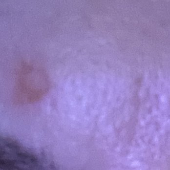 Abundance A Skincare Studio - Burn on forehead - Skin Care Near Me - Half Moon Bay, California