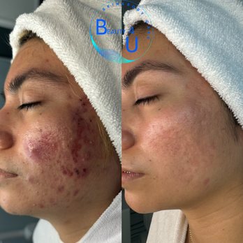 Beauty 4 U - Acne Therapy multiple session results - Skin Care Near Me - Covina, California Beauty 4 U - Acne Therapy multiple session results - Skin Care Near Me - Covina, California