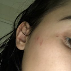 Piper Lash - Dark spots appeared after treatment