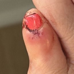 I had a pedicure yesterday and woke up to this. I'm diabetic and worried