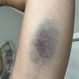 This is what you will get if you go there for a massage. Lighter one was immediately following massage, second one is next day. This is what you will get if you go there for a massage. Lighter one was immediately following massage, second one is next day.