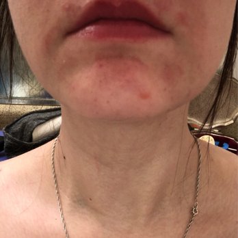 Waxing The City - Breakouts over my lip ): - Waxing Near Me - Denver, Colorado Waxing The City - Breakouts over my lip ): - Waxing Near Me - Denver, Colorado