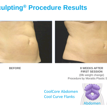 Moraitis Plastic Surgery - Coolsculpting of the abdomen by Moraitis Plastic Surgery - Cosmetic Surgeons Near Me - Palm Harbor, Florida Moraitis Plastic Surgery - Coolsculpting of the abdomen by Moraitis Plastic Surgery - Cosmetic Surgeons Near Me - Palm Harbor, Florida