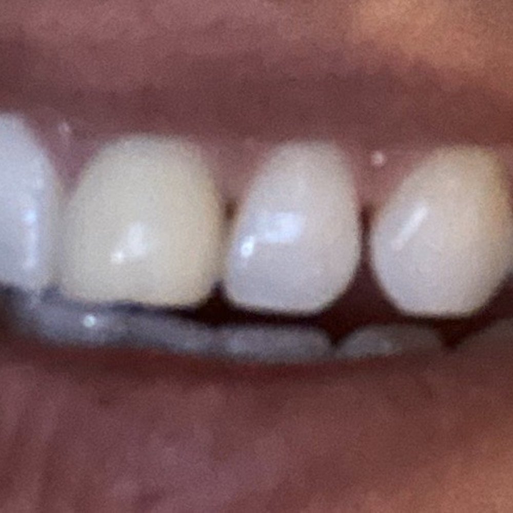 As you can see the guns reversed significantly where the teeth whitening turned the gum white.