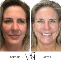 VMC Center for Regenerative Medicine - Microneedling with PRP
