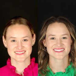 Scott Young - 20 teeth completed in 2 visits on a patient from Oklahoma