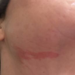 Burn from wax Burn from wax