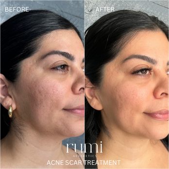 Rumi Aesthetics - Acne Scar results on our Skincare Program - Aestheticians Near Me - Chino, California