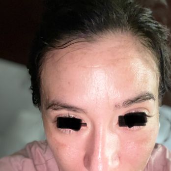 Ageless Anatomy - Brown forehead and bilateral orbit discoloration/hyperpigmentation - Naturopathic/Holistic Near Me - Phoenix, Arizona