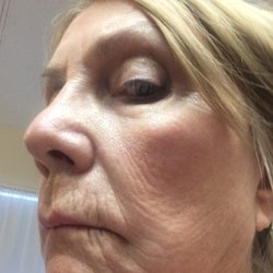 Ordon Andrew P MD Facs - Results of Dr. Andrew Ordon face lift. 18 months post op.