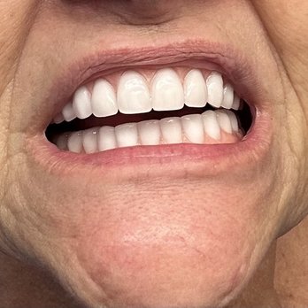 Sand Dollar Dental - They are also crooked as you can see sloping down to the left side where there is bite action - Cosmetic Dentists Near Me - Foley, Alabama