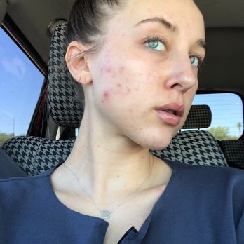 SkinFix Studios - Before skincare treatments with SkinFix Studios - Aestheticians Near Me - Scottsdale, Arizona SkinFix Studios - Before skincare treatments with SkinFix Studios - Aestheticians Near Me - Scottsdale, Arizona