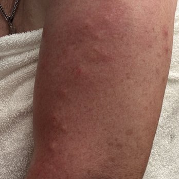 Lindy Motel - BEDBUGS!! - Hotels Near Me - Coudersport, Pennsylvania Lindy Motel - BEDBUGS!! - Hotels Near Me - Coudersport, Pennsylvania