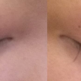 Beauty Forever - Difference between right and left lashes after 1 week. Right side looks noticeably empty, with lashes only at the center of eye - Skin Care Near Me - Bayside, New York Beauty Forever - Difference between right and left lashes after 1 week. Right side looks noticeably empty, with lashes only at the center of eye - Skin Care Near Me - Bayside, New York