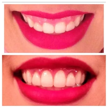 Ed De Andrade, DDS - Crownlengthening procedure before and after. - Periodontists Near Me - Henderson, Nevada Ed De Andrade, DDS - Crownlengthening procedure before and after. - Periodontists Near Me - Henderson, Nevada
