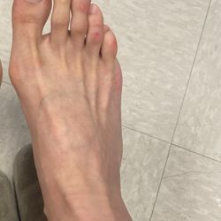 John DelMonte, DPM - Del Monte Podiatry - Right foot before surgery