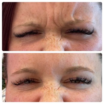 IConcierge Medspa - Bye bye angry lines! - Medical Spas Near Me - St. Petersburg, Florida