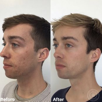 Caren Campbell, MD - Before and after, just a few months into my acne treatments with Dr. Campbell - Dermatologists Near Me - San Francisco, California Caren Campbell, MD - Before and after, just a few months into my acne treatments with Dr. Campbell - Dermatologists Near Me - San Francisco, California