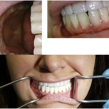 Loma Vista Dental - Before: gap at bottom center After: perfectly aligned - General Dentistry Near Me - Clovis, California Loma Vista Dental - Before: gap at bottom center After: perfectly aligned - General Dentistry Near Me - Clovis, California
