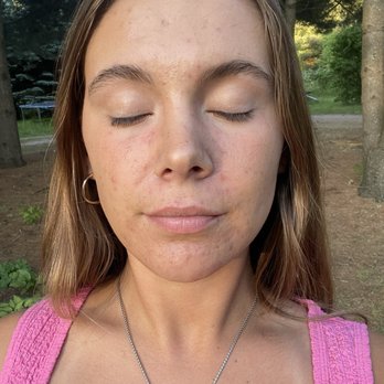 Beauty Method - After - Skin Care Near Me - Oak Park, Illinois