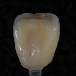 Infusion Dental Arts - Layered E.max