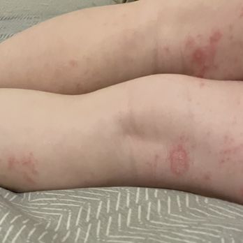 RPM Living - Our daughter had these hives all over her body. - Property Management Near Me - Austin, Texas RPM Living - Our daughter had these hives all over her body. - Property Management Near Me - Austin, Texas