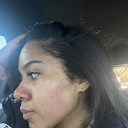 Blue Fountain Day Spa - Damage done by facial
