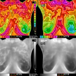 Radiant Body Thermography - This client had abnormal patterns in R breast. Risk lowered and patterns reversed in nine months!