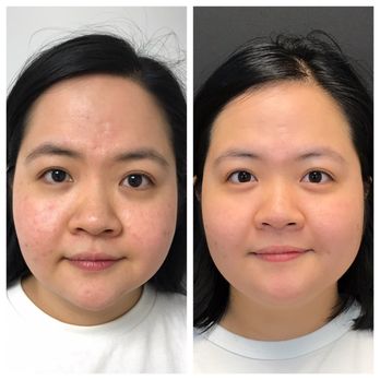 St. Louis Skin Solutions - Before & After 3 LaseMDs - Laser Hair Removal Near Me - St. Louis, Missouri St. Louis Skin Solutions - Before & After 3 LaseMDs - Laser Hair Removal Near Me - St. Louis, Missouri